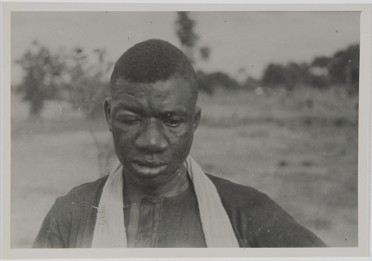 Portrait of a Man with Facial Scarring